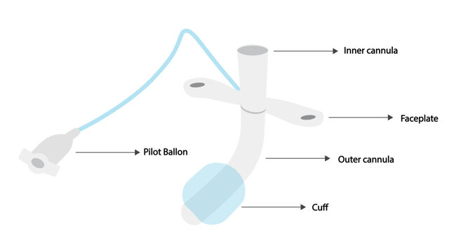 Tracheostomy device anatomy. Tracheostomy insuflated cuff.  