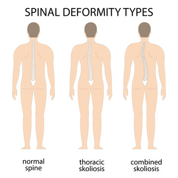 Vector illustration of spinal deformity. Kyphosis, lordosis, and scoliosis spine infographic. body posture defect. Medical, educational and scientific banner