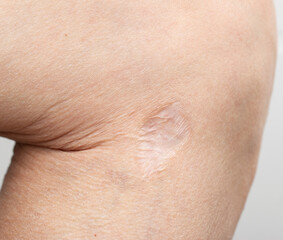 Fototapeta premium white scar on the skin of the leg as a background