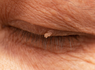 Fototapeta premium papilloma on the skin near the eyelashes on the eye
