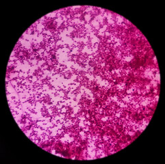 Microscopic image of vertebral lesion cytology, Inflammatory lesion, show polymorphs, lymphocytes, histiocytes,fibrous tissue, blood cell background.