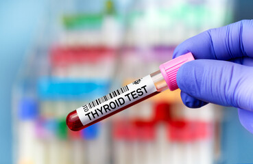 Fototapeta premium Blood tube test for Thyroid test. Blood sample tube for analysis of Thyroid gland tests in laboratory