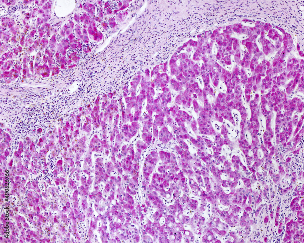 Poster human liver. cirrhosis. periodic acid schiff (pas) method.