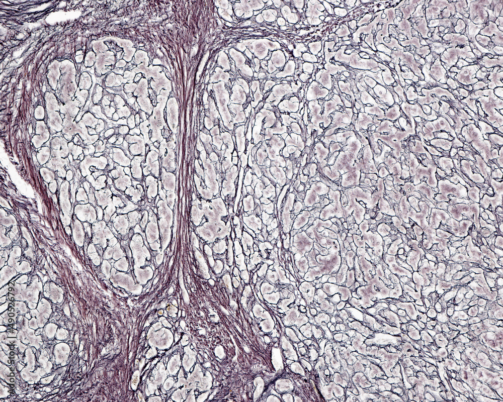 Poster human liver. cirrhosis. silver stain