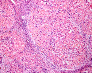 Human liver. Cirrhosis