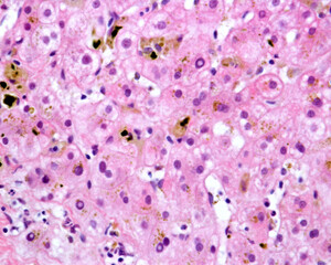 Human liver. Cholestasis. Bile pigment