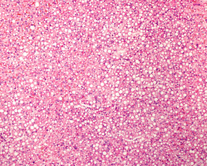 Human liver. Steatosis