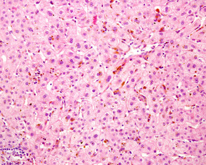 Human liver. Cholestasis. Bile pigment