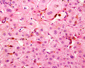 Human liver. Cholestasis. Bile pigment