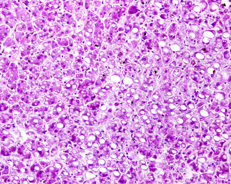 Human Liver. Steatosis. PAS Stain