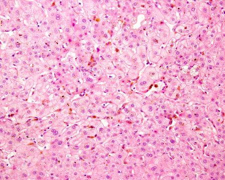 Human liver. Cholestasis. Bile pigment