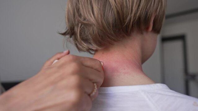 Red pustules and vesicles on the skin of the neck as symptoms of photodermatitis. Allergic reaction to sunlight. Mother rubs the child's neck.