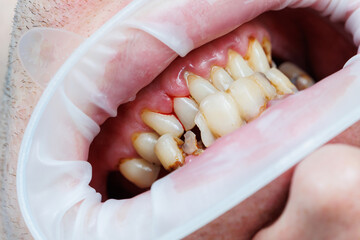 Spoiled teeth, poor dental hygiene, caries, Mouth disease. shattered teeth
