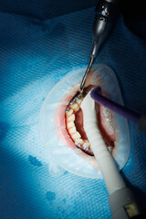 Top view of the process of brushing the patient's teeth. Teeth cleaning with water jet and saliva...