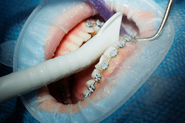 Top view of the process of brushing the patient's teeth. Teeth cleaning with water jet and saliva...