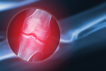 X-ray image of human knee