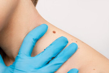 Close-up of a big mole on the young woman's neck with doctor's hand in a blue glove examining the skin isolated on a white background. The effect of sunlight on the skin