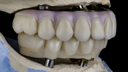 dental prostheses from zircon in the bite on models, side view on a black background