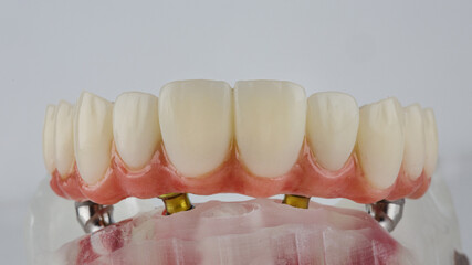 dental prosthesis of the upper jaw with a gum on the beam and a special model on a white background © Dental Pro Content
