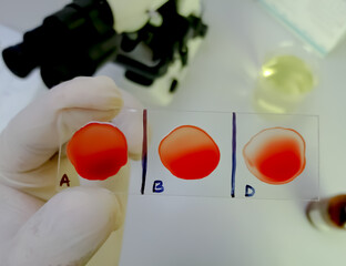 Blood group and Rh factor testing by slide agglutination method showing O negative blood group