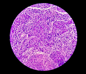 Photomicrograph of Nasopharyngeal carcinoma, nasopharynx cancer