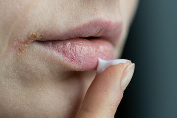 Woman applying lip balm with finger to prevent dryness and chapping in cold winter season, closeup....