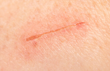Wound on human skin as a background.