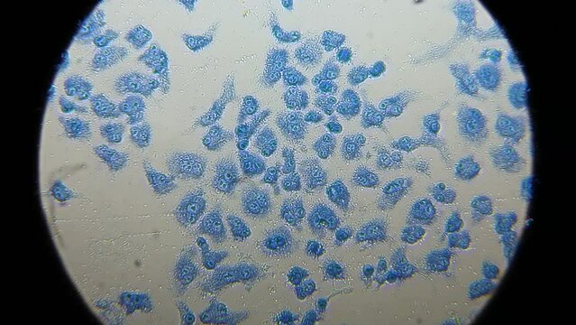 Antitumor activity experiment. Human cells under the microscope highlighted in blue color. Presence of binuclear cells