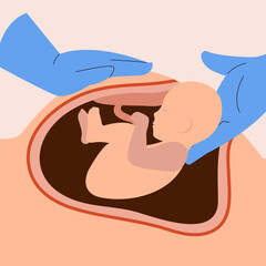 Illustration of C-section or cesarean process