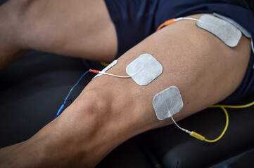 Muscle stimulator device with electrodes applied to quadriceps by a professional physiotherapist - 490705595