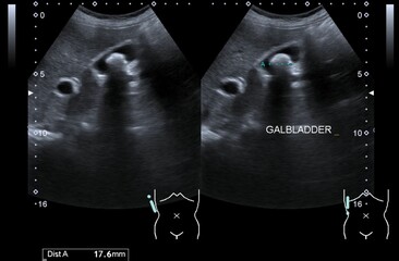 An ultrasound image of gallstone
