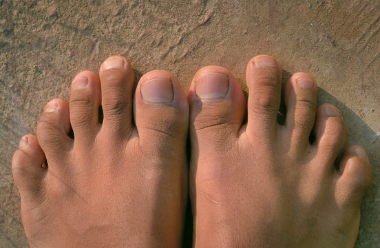 female foot with second toe longer than a big toe. Morton's foot, Greek foot, royal toe, Turkey toe, Sheppard's toe, Viking toe, Morton's syndrome, long toe or  boss toe.