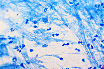 Mycobacterium tuberculosis positive (small red rod) in sputum smear, acid-fast stain, analyze by microscope 1000x