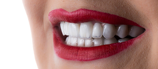 dental treatment case by ceramic crowns and veneers