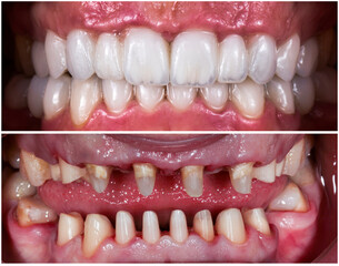 dental treatment case by ceramic crowns and veneers