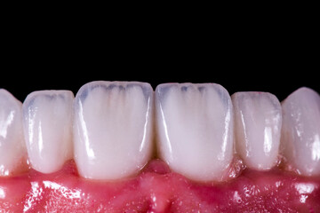 dental treatment case by ceramic crowns and veneers