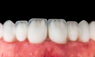 Fototapeta na wymiar dental treatment case by ceramic crowns and veneers