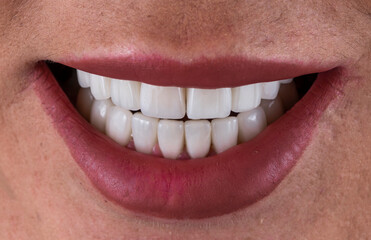 dental treatment case by ceramic crowns and veneers