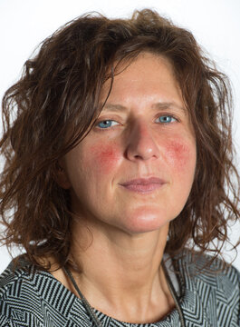 Young woman with red cheeks due to acneiform rosacea