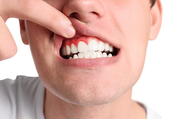 Boy showing inflamed gums on white background, closeup
