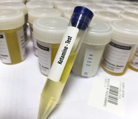 Urine sample for KET or Ketamine urine test, drug test at medical laboratory, selective focus
