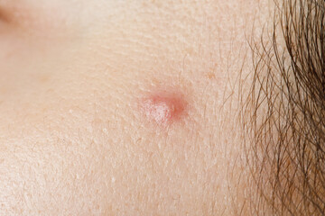 macro photo of a pimple
