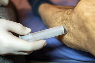 Treatment with hirudotherapy. Leeches on a man's hairy leg. The doctor uses a syringe to place the...