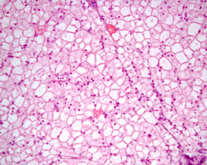 Human liver. Glycogenosis
