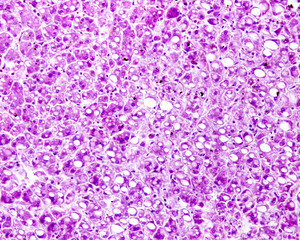 Human liver. Steatosis. PAS stain