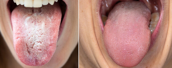Comparison between a tongue with candidiasis and a healthy tongue - obrazy, fototapety, plakaty