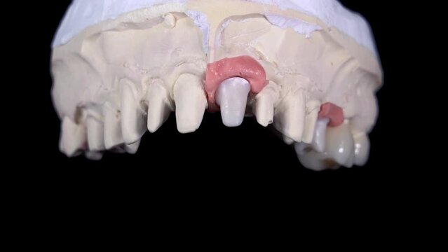 fitting dental ceramic crowns on a model of the upper jaw from plaster on a black background