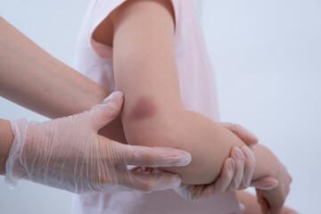 The doctor palpates the child's elbow. The traumatologist examines the site of injury. There is a bruise on the child's arm. Elbow injury - obrazy, fototapety, plakaty