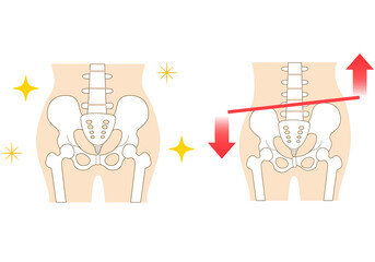 Left-right tilted pelvis and posture. - obrazy, fototapety, plakaty