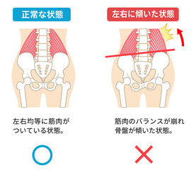 左右に傾いた骨盤と姿勢の関係